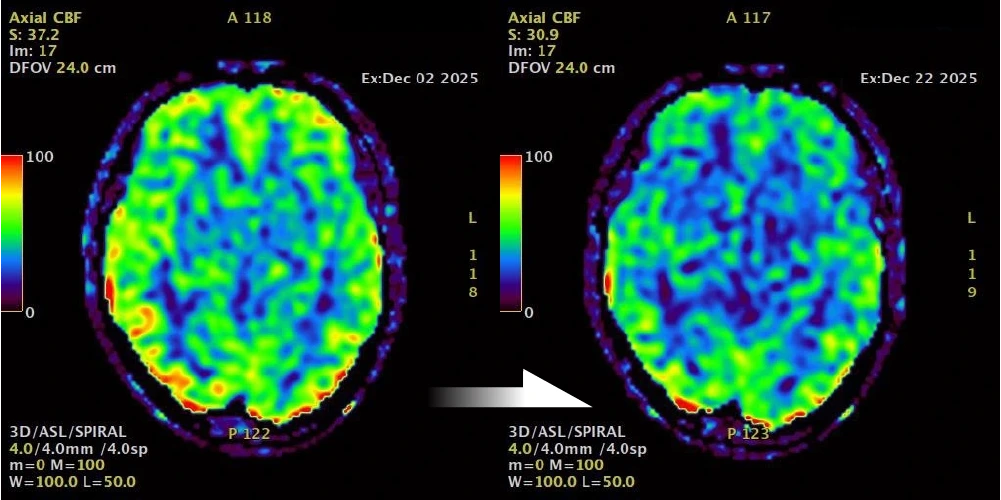 cerebral blood flow (CBF) image.before after