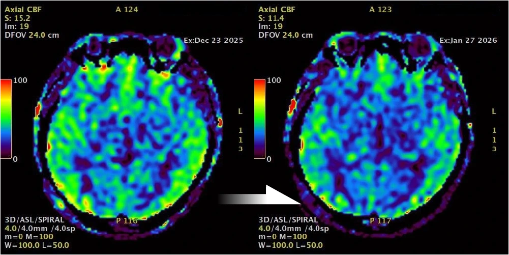 cerebral blood flow (CBF) image.before after